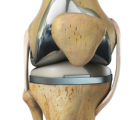 Knee Replacement